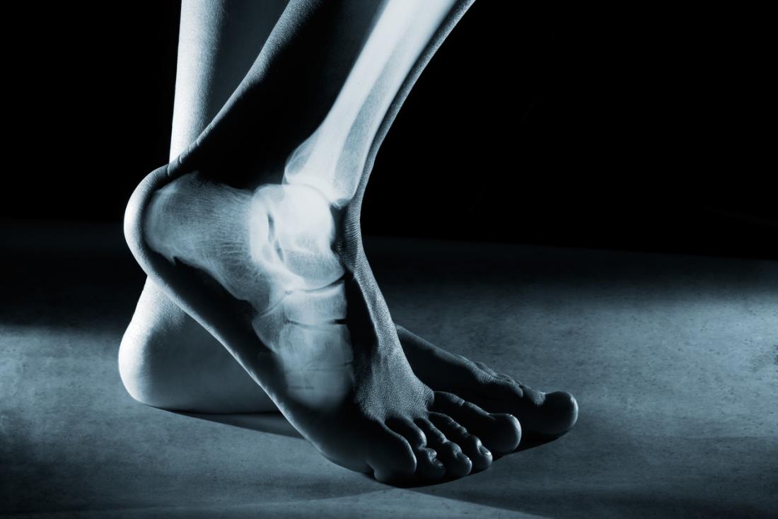 hairline fracture